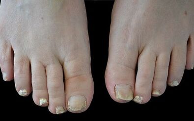 Wie man den Pilz an den Fingern loswerden