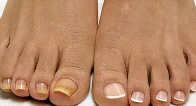 Pilze der Flottenpilzbehandlung