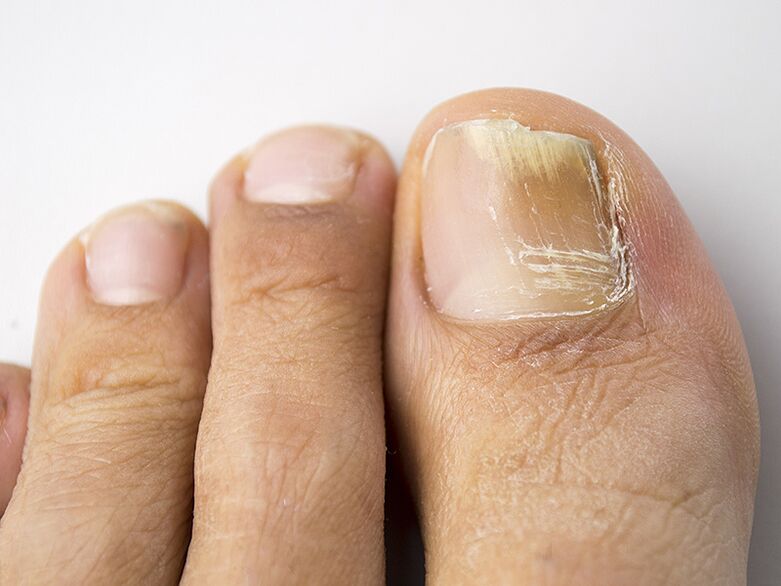 Die Anfangsphase des Pilzes