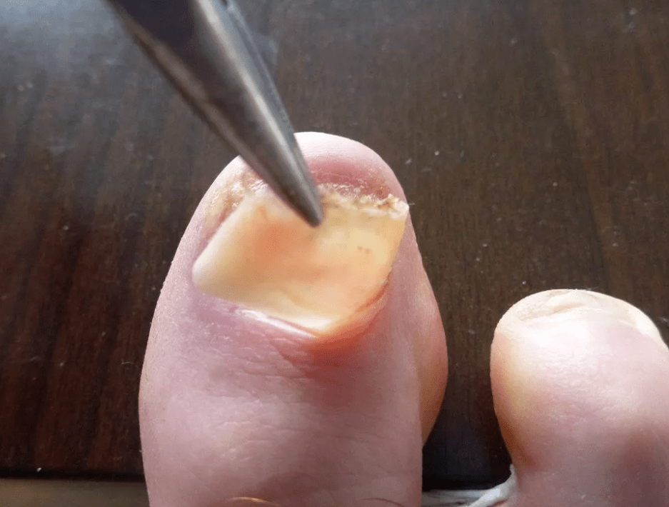 Entfernung der Platte