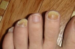 Gelbfärbung des Nagels durch Pilze